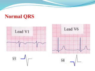 Normal QRS
V1
V6
 