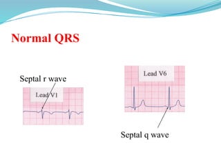 Normal QRS
Septal r wave
Septal q wave
 