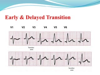 Early & Delayed Transition
•Figure 4-7
V1 V2 V3 V4 V5 V6
 
