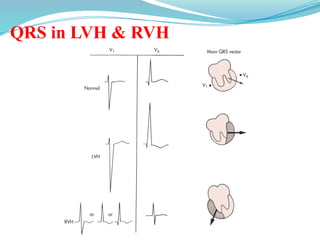 QRS in LVH & RVH
 