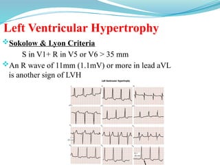 Left Ventricular Hypertrophy
Sokolow & Lyon Criteria
S in V1+ R in V5 or V6 > 35 mm
An R wave of 11mm (1.1mV) or more in lead aVL
is another sign of LVH
 