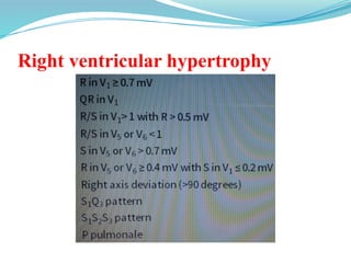 Right ventricular hypertrophy
 