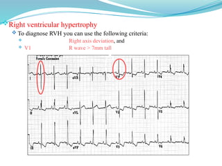 Right ventricular hypertrophy
 To diagnose RVH you can use the following criteria:
 Right axis deviation, and
 V1 R wave > 7mm tall
 