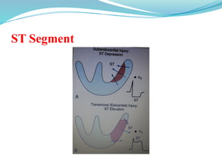 ST Segment
 