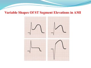 Variable Shapes Of ST Segment Elevations in AMI
Goldberger AL. Goldberger: Clinical Electrocardiography: A Simplified Approach. 7th
ed: Mosby Elsevier; 2006.
 