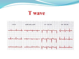 T wave
 