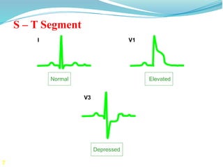 7
I
V3
V1
Normal
Depressed
Elevated
S – T Segment
 