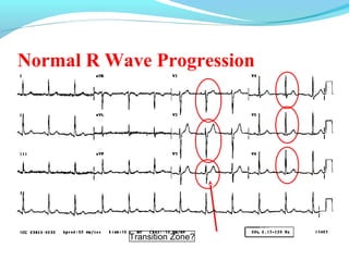 Normal R Wave Height Basics of Electrocardiography(ECG) | PPT