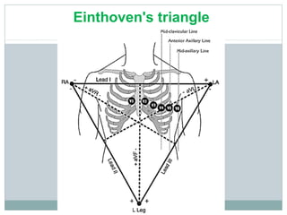 Einthoven's triangle
 