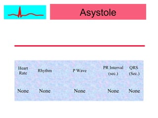 Asystole
Heart
Rate
Rhythm P Wave
PR Interval
(sec.)
QRS
(Sec.)
None None None None None
 