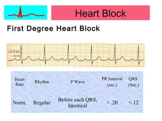 Heart Block
First Degree Heart Block
Heart
Rate
Rhythm P Wave
PR Interval
(sec.)
QRS
(Sec.)
Norm. Regular
Before each QRS,
Identical
> .20 <.12
 