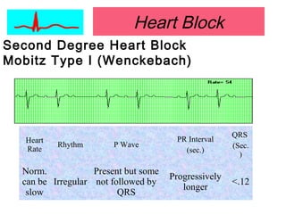 Heart Block
Second Degree Heart Block
Mobitz Type I (Wenckebach)
Heart
Rate
Rhythm P Wave
PR Interval
(sec.)
QRS
(Sec.
)
Norm.
can be
slow
Irregular
Present but some
not followed by
QRS
Progressively
longer
<.12
 