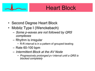 Heart Block
• Second Degree Heart Block
• Mobitz Type I (Wenckebach)
– Some p-waves are not followed by QRS
complexes
– Rhythm is irregular
• R-R interval is in a pattern of grouped beating
– Rate 60-100 bpm
– Intermittent Block at the AV Node
• Progressively prolonged p-r interval until a QRS is
blocked completely
 