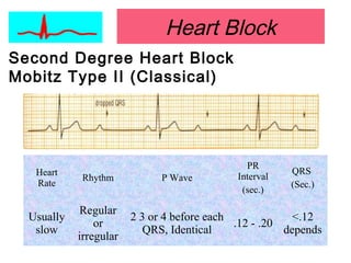 Heart Block
Second Degree Heart Block
Mobitz Type II (Classical)
Heart
Rate
Rhythm P Wave
PR
Interval
(sec.)
QRS
(Sec.)
Usually
slow
Regular
or
irregular
2 3 or 4 before each
QRS, Identical
.12 - .20
<.12
depends
 