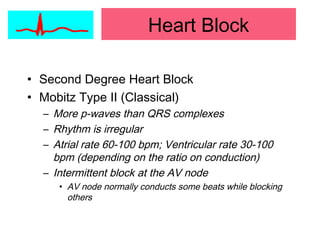 Heart Block
• Second Degree Heart Block
• Mobitz Type II (Classical)
– More p-waves than QRS complexes
– Rhythm is irregular
– Atrial rate 60-100 bpm; Ventricular rate 30-100
bpm (depending on the ratio on conduction)
– Intermittent block at the AV node
• AV node normally conducts some beats while blocking
others
 