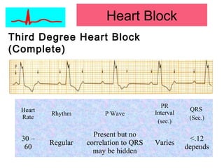 Heart Block
Third Degree Heart Block
(Complete)
Heart
Rate
Rhythm P Wave
PR
Interval
(sec.)
QRS
(Sec.)
30 –
60
Regular
Present but no
correlation to QRS
may be hidden
Varies
<.12
depends
 