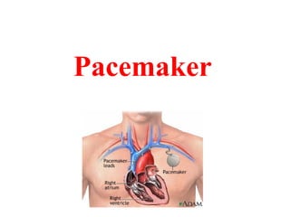 Pacemaker
 