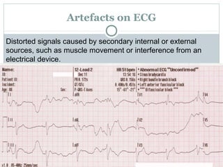 Artefacts on ECG
Distorted signals caused by secondary internal or external
sources, such as muscle movement or interference from an
electrical device.
 