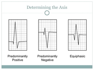 Determining the Axis
Predominantly
Positive
Predominantly
Negative
Equiphasic
 