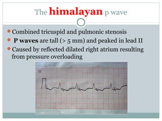 The himalayan p wave
Combined tricuspid and pulmonic stenosis
 P waves are tall (> 5 mm) and peaked in lead II
Caused by reflected dilated right atrium resulting
from pressure overloading
 