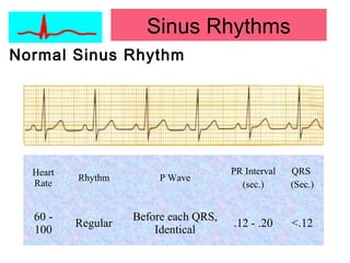 Normal Sinus Rhythm
Heart
Rate
Rhythm P Wave
PR Interval
(sec.)
QRS
(Sec.)
60 -
100
Regular
Before each QRS,
Identical
.12 - .20 <.12
Sinus Rhythms
 