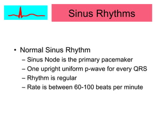 • Normal Sinus Rhythm
– Sinus Node is the primary pacemaker
– One upright uniform p-wave for every QRS
– Rhythm is regular
– Rate is between 60-100 beats per minute
Sinus Rhythms
 