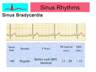 Sinus Bradycardia
Heart
Rate
Rhythm P Wave
PR Interval
(sec.)
QRS
(Sec.)
<60 Regular
Before each QRS,
Identical
.12 - .20 <.12
Sinus Rhythms
 