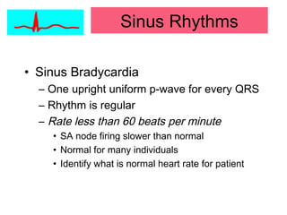 • Sinus Bradycardia
– One upright uniform p-wave for every QRS
– Rhythm is regular
– Rate less than 60 beats per minute
• SA node firing slower than normal
• Normal for many individuals
• Identify what is normal heart rate for patient
Sinus Rhythms
 