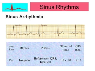 Sinus Arrhythmia
Heart
Rate
Rhythm P Wave
PR Interval
(sec.)
QRS
(Sec.)
Var. Irregular
Before each QRS,
Identical
.12 - .20 <.12
Sinus Rhythms
 