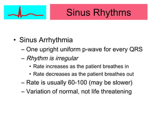 • Sinus Arrhythmia
– One upright uniform p-wave for every QRS
– Rhythm is irregular
• Rate increases as the patient breathes in
• Rate decreases as the patient breathes out
– Rate is usually 60-100 (may be slower)
– Variation of normal, not life threatening
Sinus Rhythms
 
