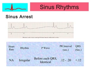 Sinus Arrest
Heart
Rate
Rhythm P Wave
PR Interval
(sec.)
QRS
(Sec.)
NA Irregular
Before each QRS,
Identical
.12 - .20 <.12
Sinus Rhythms
 