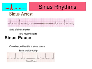 Sinus Rhythms
Stop of sinus rhythm
New rhythm starts
One dropped beat is a sinus pause
Beats walk through
Sinus Pause
 