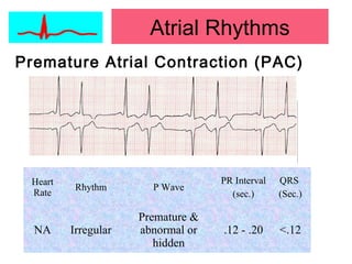Premature Atrial Contraction (PAC)
Heart
Rate
Rhythm P Wave
PR Interval
(sec.)
QRS
(Sec.)
NA Irregular
Premature &
abnormal or
hidden
.12 - .20 <.12
Atrial Rhythms
 