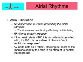 • Atrial Fibrillation
– No discernable p-waves preceding the QRS
complex
• The atria are not depolarizing effectively, but fibrillating
– Rhythm is grossly irregular
– If the heart rate is <100 it is considered controlled
a-fib, if >100 it is considered to have a “rapid
ventricular response”
– AV node acts as a “filter”, blocking out most of the
impulses sent by the atria in an attempt to control
the heart rate
Atrial Rhythms
 