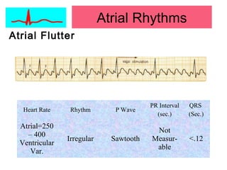 Atrial Flutter
Heart Rate Rhythm P Wave
PR Interval
(sec.)
QRS
(Sec.)
Atrial=250
– 400
Ventricular
Var.
Irregular Sawtooth
Not
Measur-
able
<.12
Atrial Rhythms
 