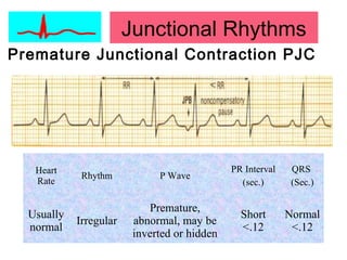Premature Junctional Contraction PJC
Heart
Rate
Rhythm P Wave
PR Interval
(sec.)
QRS
(Sec.)
Usually
normal
Irregular
Premature,
abnormal, may be
inverted or hidden
Short
<.12
Normal
<.12
Junctional Rhythms
 