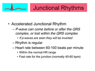 • Accelerated Junctional Rhythm
– P-wave can come before or after the QRS
complex, or lost within the QRS complex
• If p-waves are seen they will be inverted
– Rhythm is regular
– Heart rate between 60-100 beats per minute
• Within the normal HR range
• Fast rate for the junction (normally 40-60 bpm)
Junctional Rhythms
 