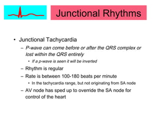 • Junctional Tachycardia
– P-wave can come before or after the QRS complex or
lost within the QRS entirely
• If a p-wave is seen it will be inverted
– Rhythm is regular
– Rate is between 100-180 beats per minute
• In the tachycardia range, but not originating from SA node
– AV node has sped up to override the SA node for
control of the heart
Junctional Rhythms
 