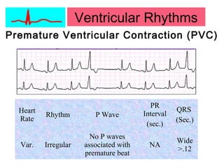 Ventricular Rhythms
Premature Ventricular Contraction (PVC)
Heart
Rate
Rhythm P Wave
PR
Interval
(sec.)
QRS
(Sec.)
Var. Irregular
No P waves
associated with
premature beat
NA
Wide
>.12
 