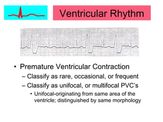 Ventricular Rhythm
• Premature Ventricular Contraction
– Classify as rare, occasional, or frequent
– Classify as unifocal, or multifocal PVC’s
• Unifocal-originating from same area of the
ventricle; distinguished by same morphology
 