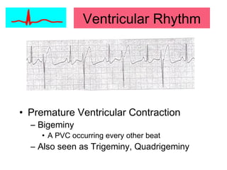 Ventricular Rhythm
• Premature Ventricular Contraction
– Bigeminy
• A PVC occurring every other beat
– Also seen as Trigeminy, Quadrigeminy
 