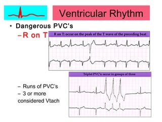 Ventricular Rhythm
• Dangerous PVC’s
– R on T
– Runs of PVC’s
– 3 or more
considered Vtach
 