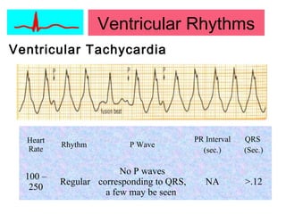 Ventricular Rhythms
Ventricular Tachycardia
Heart
Rate
Rhythm P Wave
PR Interval
(sec.)
QRS
(Sec.)
100 –
250
Regular
No P waves
corresponding to QRS,
a few may be seen
NA >.12
 