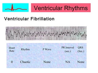 Ventricular Rhythms
Ventricular Fibrillation
Heart
Rate
Rhythm P Wave
PR Interval
(sec.)
QRS
(Sec.)
0 Chaotic None NA None
 