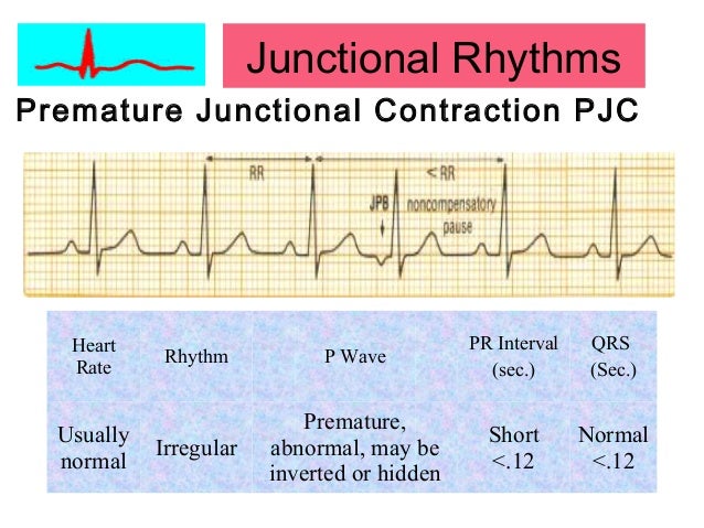 Basics Of Electrocardiography Arrhythmia Pacemaker
