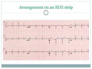 Arrangement on an ECG strip
 