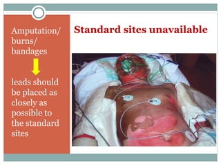 Standard sites unavailableAmputation/
burns/
bandages
leads should
be placed as
closely as
possible to
the standard
sites
 