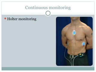 Continuous monitoring
Holter monitoring
 