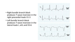 • Right bundle branch block
produces T-wave inversion in the
right precordial leads V1-3
• Left bundle branch block
produces T-wave inversion in the
lateral leads I, aVL and V5-6
 