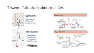 T wave- Pottasium abnormalities
 